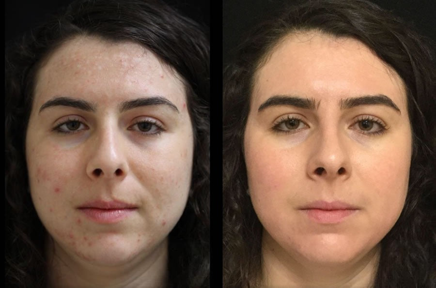 Melasma, Pigmentation, Darkspot Combo For All Skin Types (5 Items)