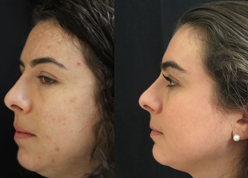 Melasma, Pigmentation, Darkspot Combo For All Skin Types (5 Items)